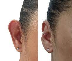 CORRECTOR DE OREJAS